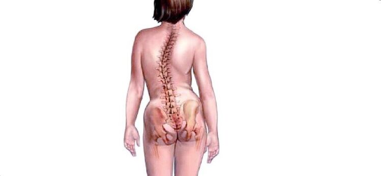 osteochondroză