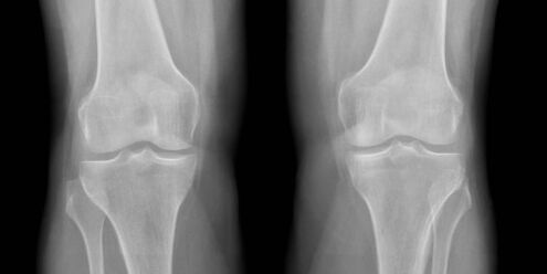 artroza genunchiului la radiografie